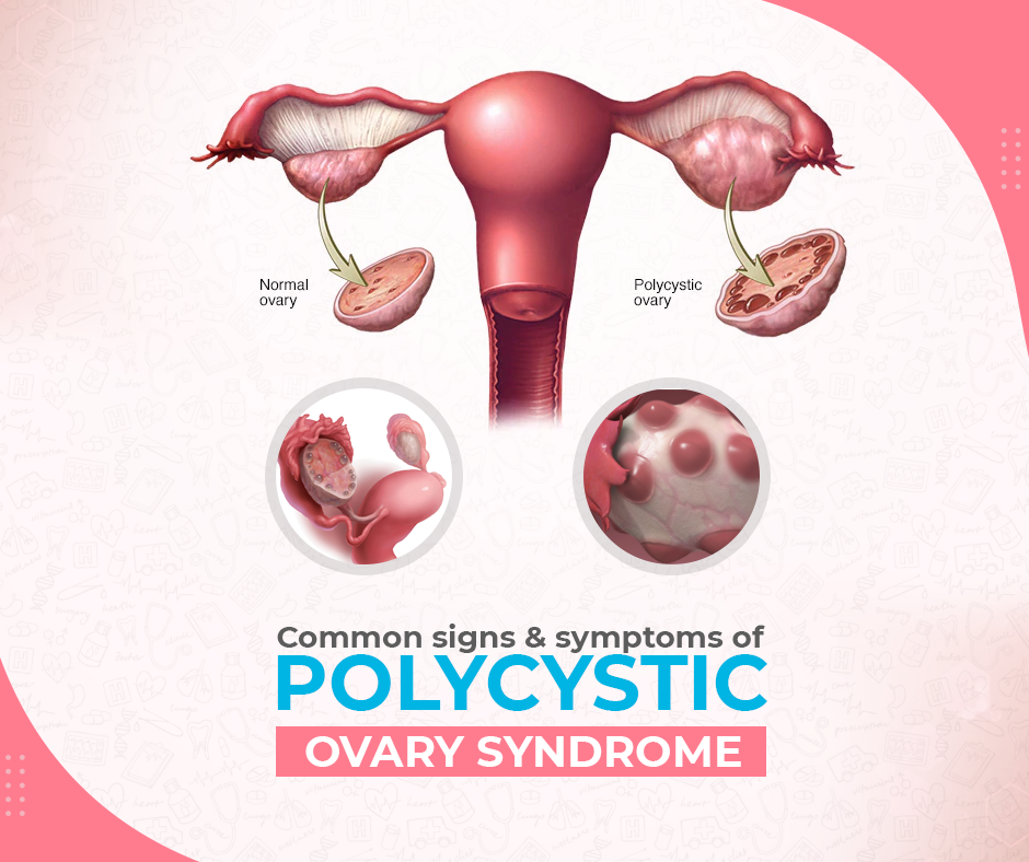 What are common signs and symptoms of polycystic ovary syndrome (PCOS)?